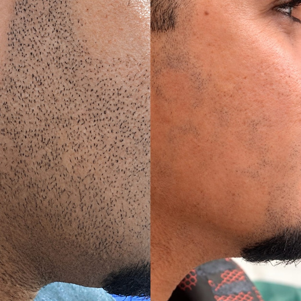 Comparativo de depilação a laser na barba masculina com antes e depois